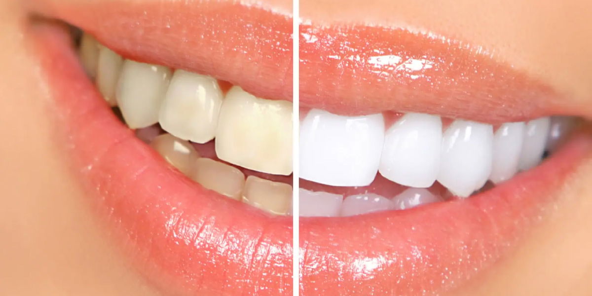 teeth whitening at home